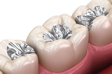 amalgaabfälle-zahn-zähne-zahnfleisch